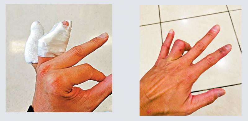 ﻿妍之有理不能伸直的手指屈颖妍