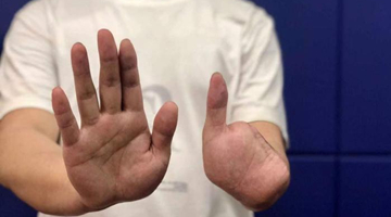 四川男子被骗至缅北 拒绝电诈被剁4根手指