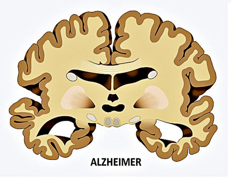 ﻿带氧运动/提升认知障碍症患者认知能力