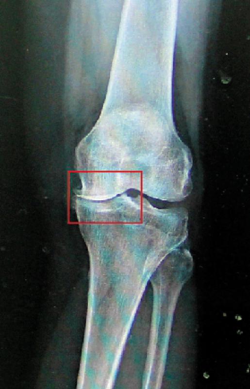 ﻿适当保养/不同年龄护膝须知