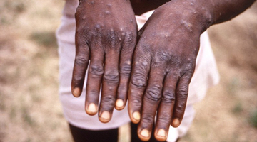 俄媒：至少4家美生物实验室在猴痘起源地运行