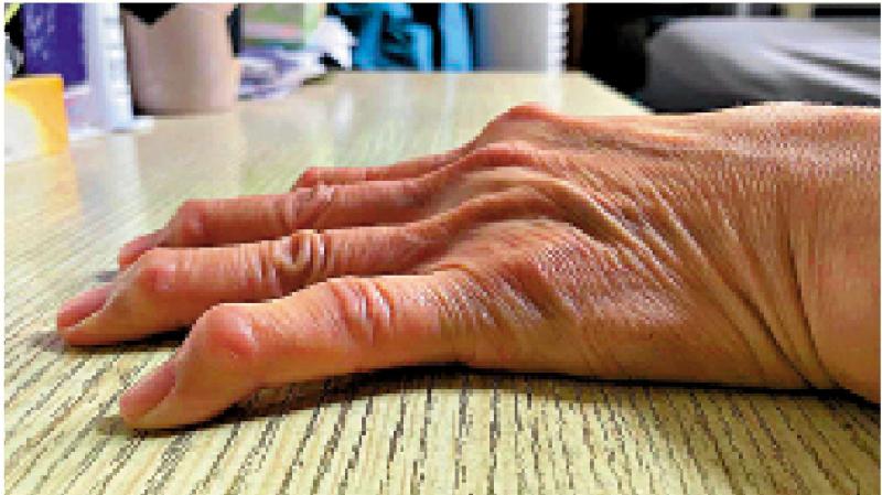 ﻿中医．生活/掌指关节扭挫伤 须及时处理