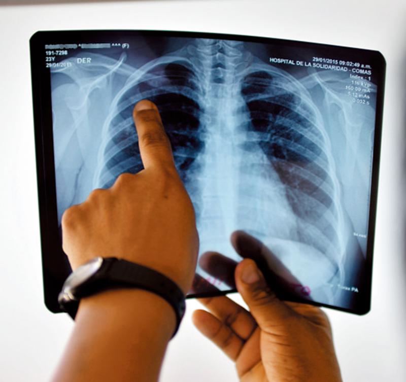 ﻿研究结果/AI可帮助诊断胸片