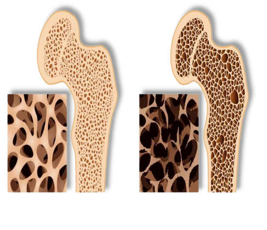 年轻人也要注意!骨质疏松不再是老年病，衰老细胞正在悄然侵袭你的骨骼!