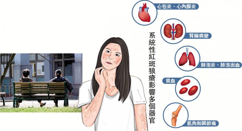 ﻿红斑狼疮可累及多器官组织发炎